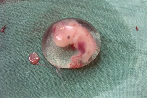 Human Fetus