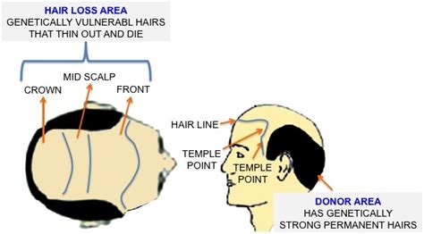 Good Bye Hair Loss - Hair Loss Tips & Advice Online: Why the transplanted hair grow permanently?