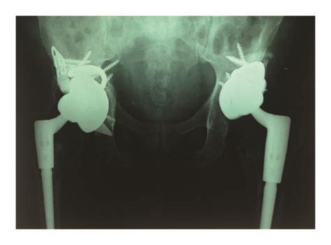 Postoperative Anteroposterior Pelvic Plain Film Radiographs Showing