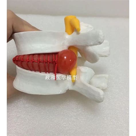 Insan Lomber Disk Hernisi Modeli G Steri Modeli Lomber Vertebral Omurga