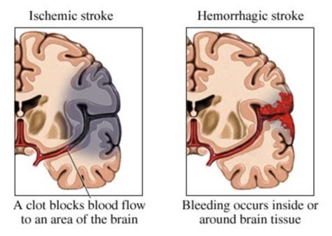 Cerebrovascular Disease And Infarct Ischemic Strokes Flashcards