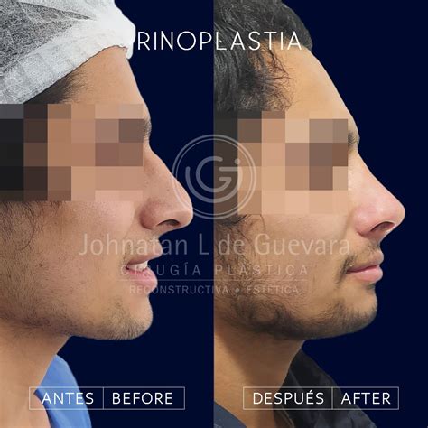 Rinoplastia Bogot Luce La Nariz Que Siempre So Aste Dr Guevara