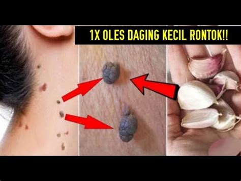 Kutil Skin Tag Rontok Dalam Semalam Pakai Bawang Putih Dan Kapur