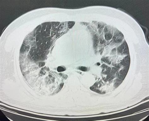 感染新冠后哪些情况需要做CT 新冠 CT 感染 症状 健康界