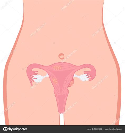 Uterine Fibroid Vector Illustration Stock Vector Image By ©crazy