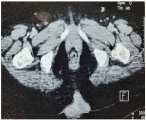 Strangulated Hernia With Appendicitis A Rare Case Of Amyand S Hernia