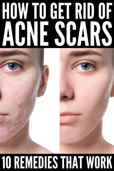 Ideal Tips About How To Get Rid Of Acne Scars Without Surgery Waterask