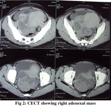 Figure 2 From A Rare Association Of Trousseau’s Syndrome With Ovarian Serous Cystadenocarcinoma