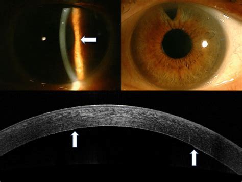 Slit Lamp Photos Top And Corneal Oct Bottom Of The Index Patient In