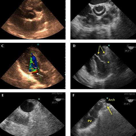 A Short Axis Mid Systolic View Of Aortic Valve In Transthoracic