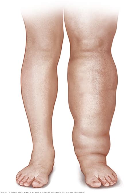 Lymphedema Symptoms And Causes Mayo Clinic