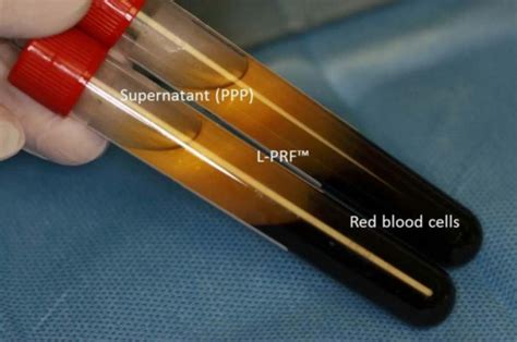 Platelet Rich Fibrin Therapy What Is Prf Prp Injection Md Center