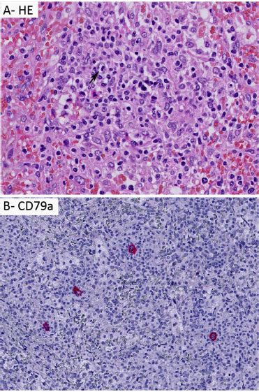 Nodular Lymphocyte Predominant Hodgkin Lymphoma Pathology Clinical Course And Relation To T