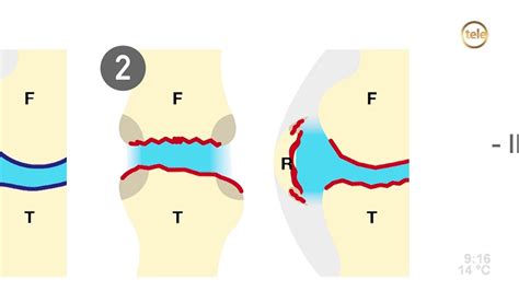 Artrosis De Rodilla Nuevos Tratamientos Parte Dr Isaac Jakter