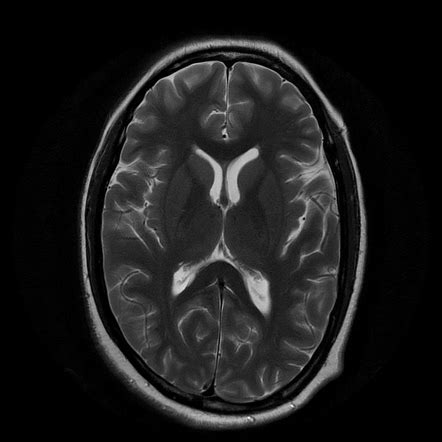 Tuberculous Meningitis Radiology Case Radiopaedia Org