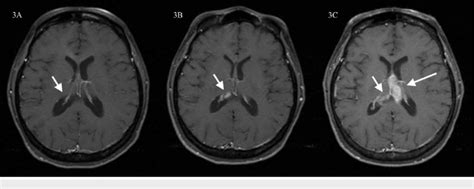 Post Contrast Axial T Weighted Image Mri Of The Brain At Two Figure