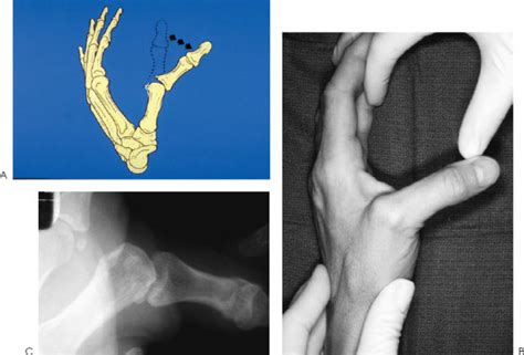 Ulnar Collatreal Ligament Injuries Skiers Thumb” Musculoskeletal Key