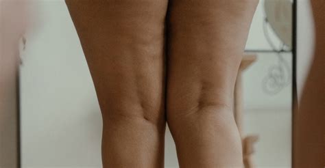 Inner Thigh Chafing: Causes and Ways to Treat It – Thigh Society Canada