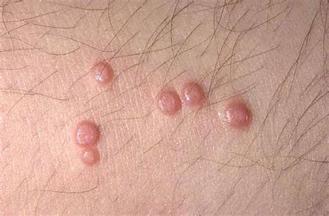 Molluscum Contagiosum Symptoms