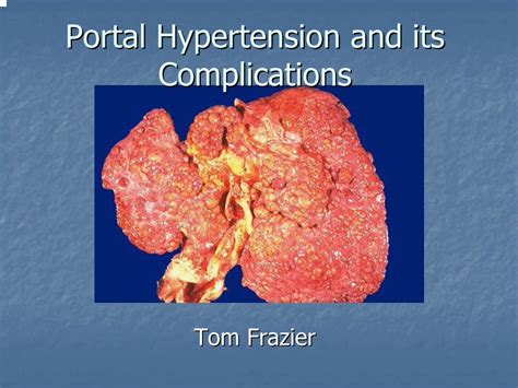 (PDF) Portal Hypertension and its Complications - DOKUMEN.TIPS