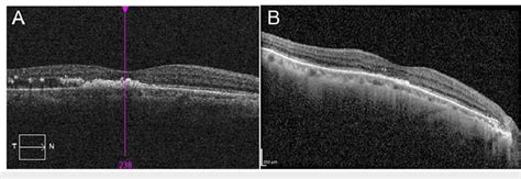 Sd Oct Imaging Showing Macula Of The Right Eye Pre And Post Argon Laser