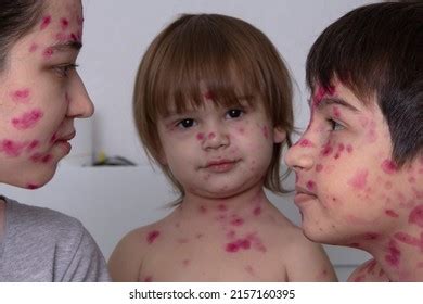 Chickenpox Chickenpox Adults Children Infectious Disease Stock Photo 2157160395 | Shutterstock