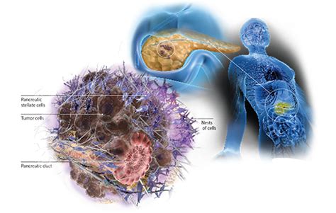 Pancreatic Cancer Cells