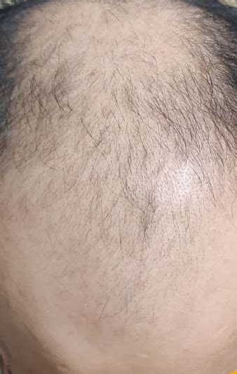 Microneedling With Minoxidil And Finasteride 4 Months Out Photos