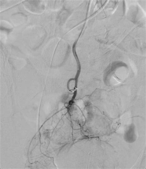 Pre Embolization Angiogram Showing A Bleeding Pseudoaneurysm Arising