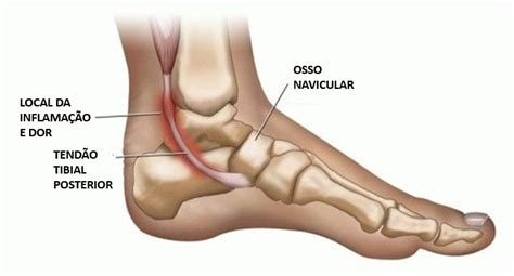 Tendinopatia Do Tibilal Posterior Causa E Diagn Stico