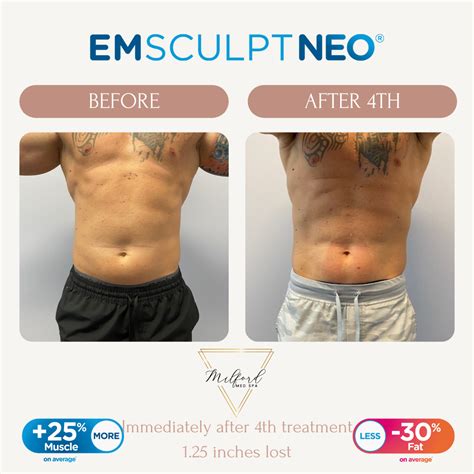 Emsculpt Milford Med Spa