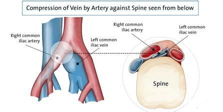 INTRAVASCULAR ULTRASOUND (IVUS) AND LEG SWELLING - South Bay Vascular ...