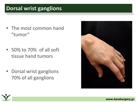 Arthroscopic Treatment Of Dorsal Wrist Ganglions Ppt