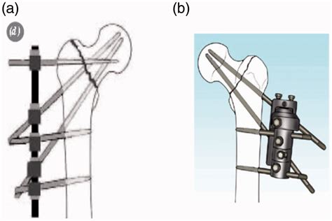 The Two Main Types Of External Fixators Used For Treatment Of Hip