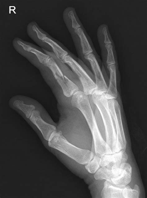 Proximal Phalanx Fracture Image