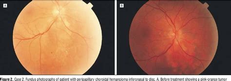 Figure 2 From Choroidal Hemangioma Treated With Photodynamic Therapy