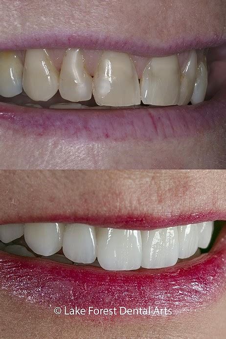 Veneers Before And After What To Expect From The Experience