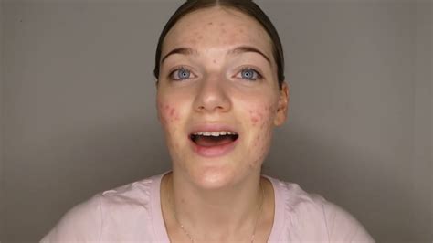 My Roaccutane Journey 3 Month Update Youtube