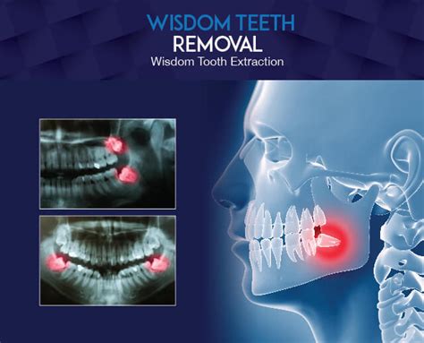 Wisdom Teeth Removal/ Wisdom Tooth Extraction