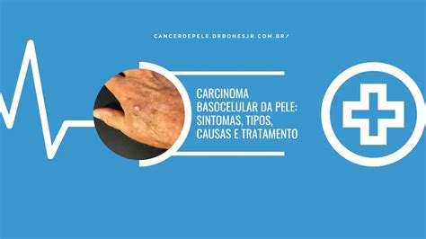 Carcinoma Basocelular Da Pele Sintomas Causas E Tratamento