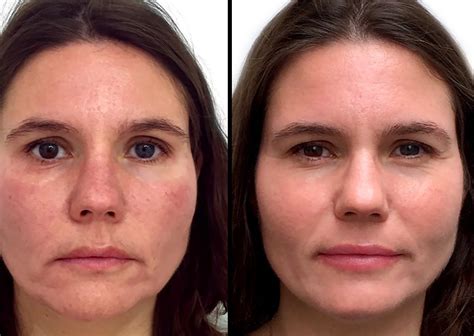 Lipofilling Visage Rajeunissement Facial Transfert De Graisse