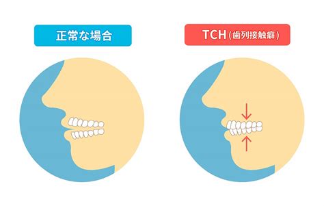 歯ぎしり・食いしばりによるかみ合わせ治療なら宮崎市佐土原の【ひなた歯科・矯正歯科】