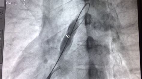 T Cnica Exitosa De Arteriograf A Pulmonar Y Angioplast A V Lvular