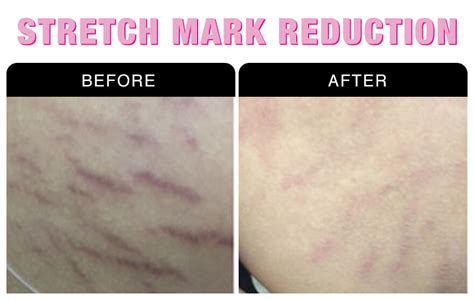 Stretch Mark Reduction National Laser Institute Medical Spa