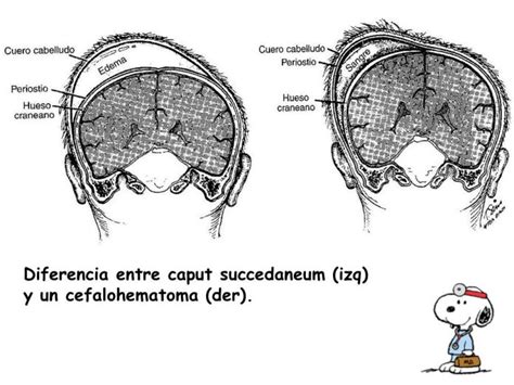 Diferencias Entre Caput Succedaneum Y Cefalohematoma Soluci N