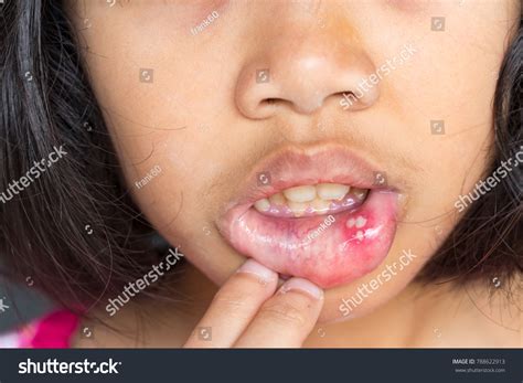 Mouth Ulcer Canker Sore Aphthous Stomatitis Stock Photo Edit Now