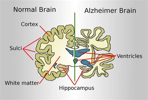 Gene Therapy Triggers Functional Cell Growth Of Degenerating Neurons In