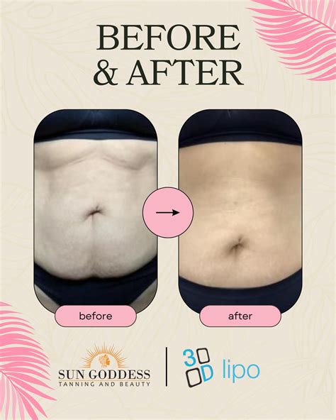 Sun - Take a look at our 3D lipo before and after transformation! These