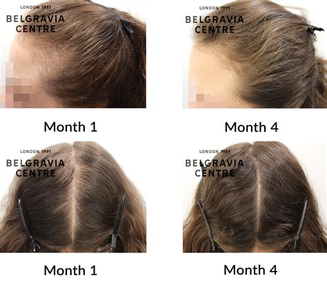 Hair Loss Success Story I Am So Glad I Took The Opportunity To Go To