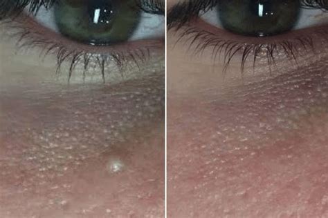 Milia Xanthelasma Syringoma Fibrous Papules Treatment